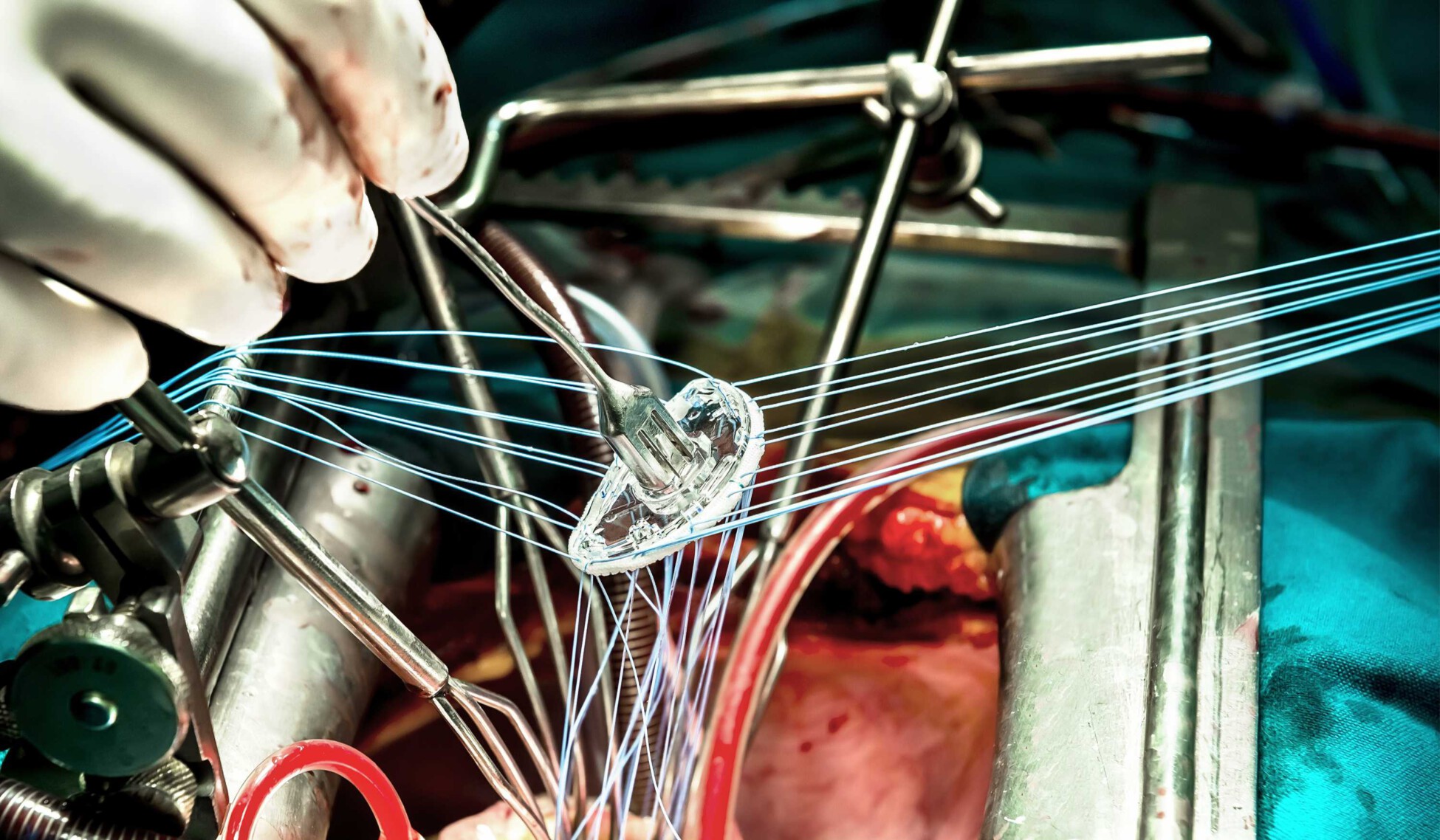 Heart failure, medical support or transplant